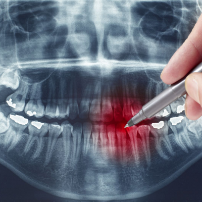 Чому стоматологи не радять їсти дуже гарячу їжу